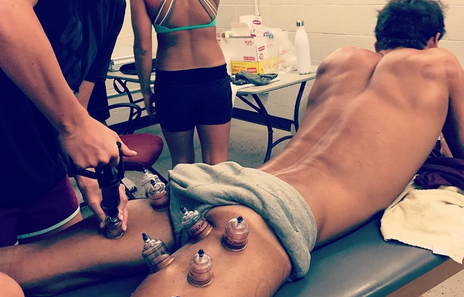 Michael Phelps using cupping while becoming the greatest Olympic athlete of all time