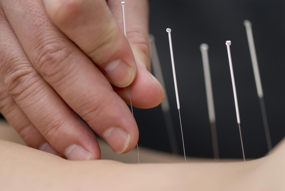 Acupuncture found to help treat men with erectile dysfunction and fertility issues