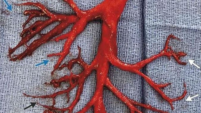 Advertencia de inyección de coágulo: así es como se ve un coágulo de sangre cuando la sangre LÍQUIDA se convierte en una masa gelatinosa semisólida dentro de su cuerpo